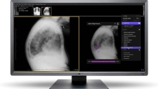 Harrison.ai's flagship product Annalise CXR