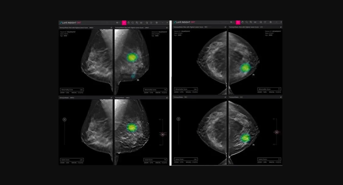 
  A sample scan analysis of Lunit INSIGHT DBT

